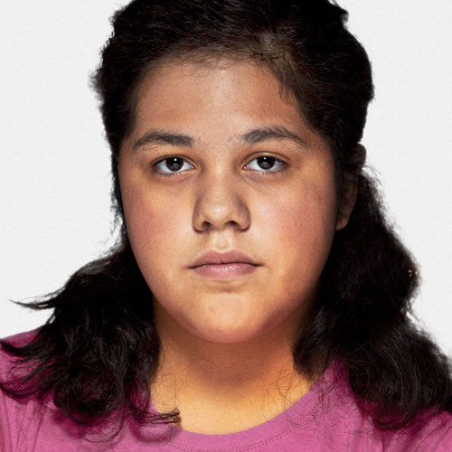 Laura B s Story Severe Dog Bite Injuries To A Little Girl Richard laura-b-s-story-severe-dog-bite-injuries-to-a-little-girl-richard