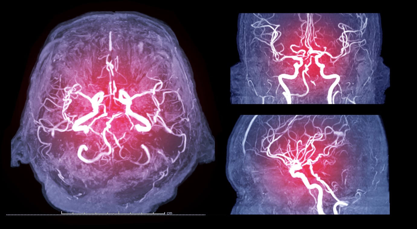 gadolinium mri